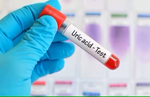 10 أمراض تسبب ارتفاع مستويات حمض اليوريك