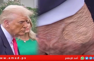 البيت الأبيض يكشف الحالة الصحية لترامب والأورام على يديه