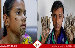 مرض نادر يحول جلد المصابين ليشبه أغصان الشجر - تفاصيل