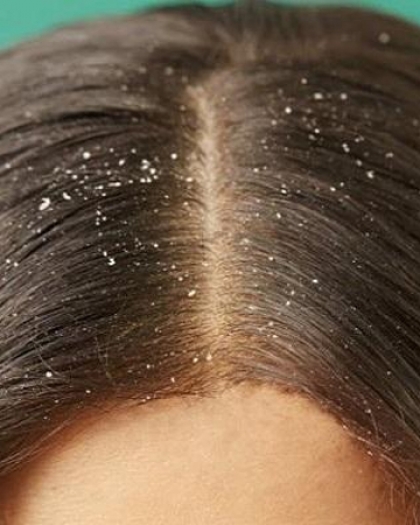 وصفات طبيعية للتخلص من قشرة الشعر الدهنية